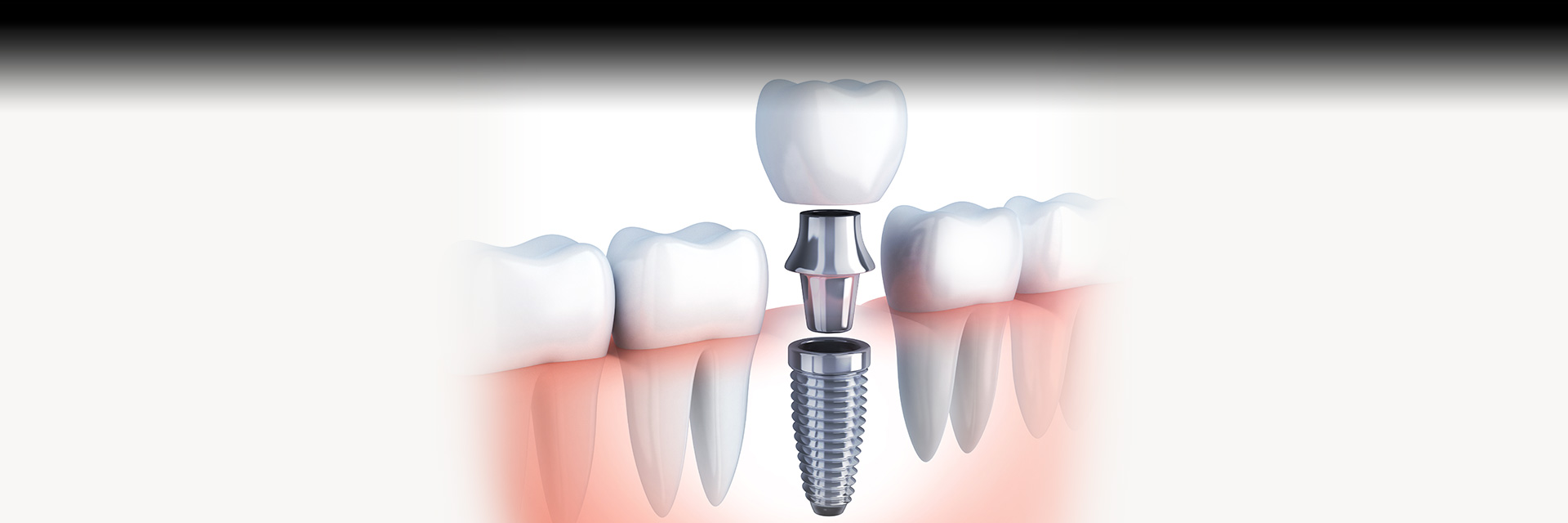 Dental Implants at Greg G Pitts DDS