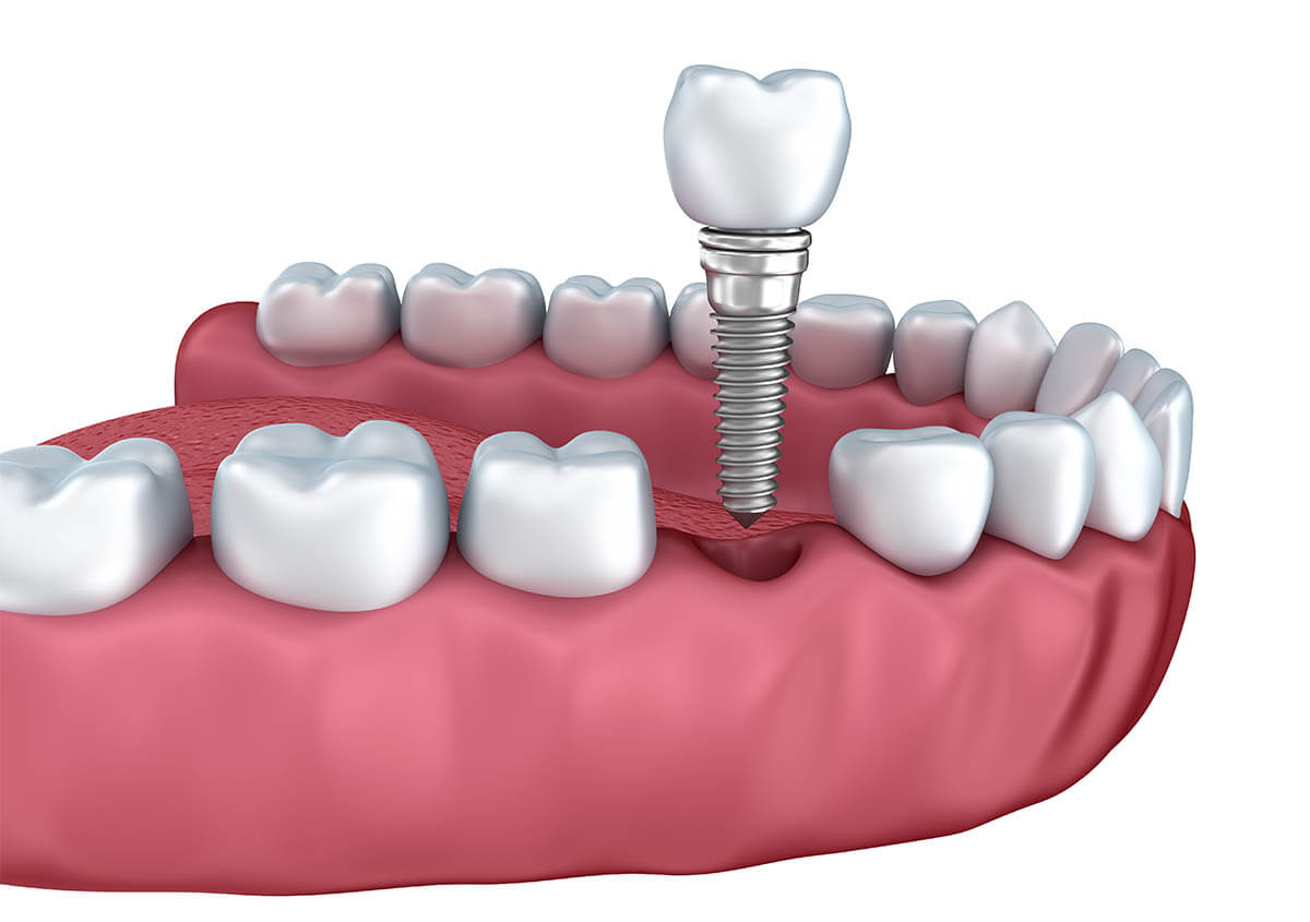 Bone Loss after Dental Implant in American Fork UT Area