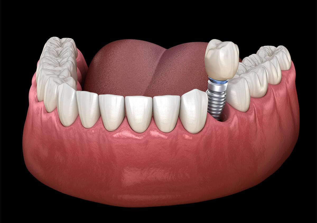 Dental Implant Services in American Fork Utah Area